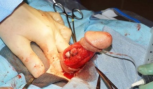Penis enlargement surgery